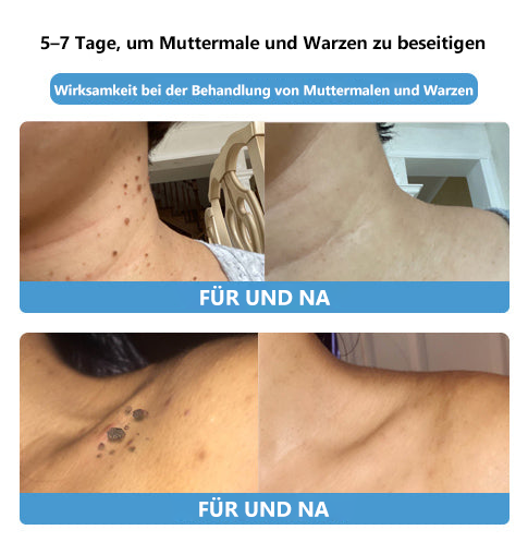 🌻🐝[🍀Offizieller Markenshop🍀] LEFUN™ Bienengift Maulwurf und Warze Behandlung Creme(👨‍⚕AAD EMPFIEHLT)