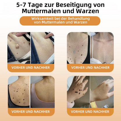 👑👑LIPOGO™ Bienengift Warze & Tag Entfernung Creme(👨‍⚕Für alle Hauttypen geeignet)🐝(🔥Aktion am letzten Tag 70% Rabatt)