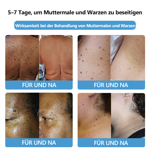 🌻🐝[🍀Offizieller Markenshop🍀] LEFUN™ Bienengift Maulwurf und Warze Behandlung Creme(👨‍⚕AAD EMPFIEHLT)