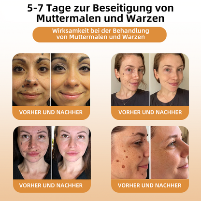 👑👑LIPOGO™ Bienengift Warze & Tag Entfernung Creme(👨‍⚕Für alle Hauttypen geeignet)🐝(🔥Aktion am letzten Tag 70% Rabatt)