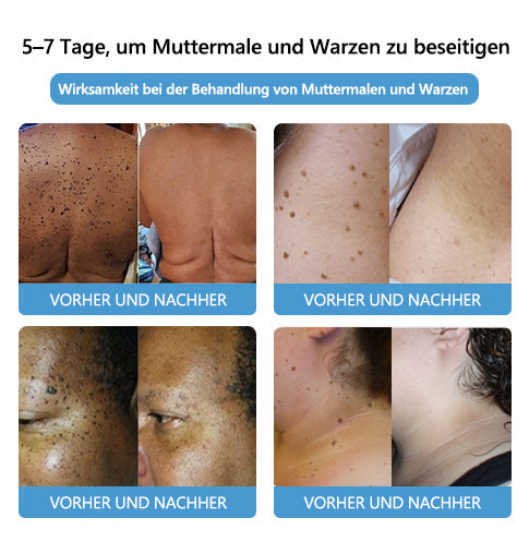 🌻🐝[🌟Offizieller Markenshop🌟] LEFUN™ Bienengift Maulwurf und Warze Behandlung Creme(👨‍⚕AAD EMPFIEHLT)