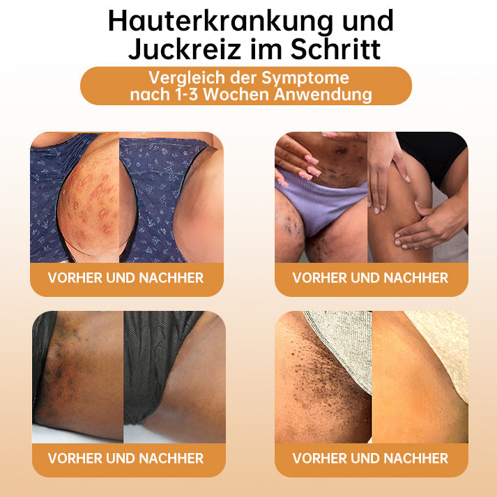 👑👑LIPOGO™ Bienengift Warze & Tag Entfernung Creme(👨‍⚕Für alle Hauttypen geeignet)🐝(🔥Aktion am letzten Tag 70% Rabatt)