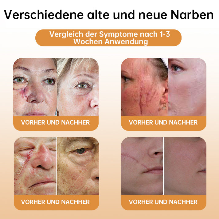 👑👑LIPOGO™ Bienengift Warze & Tag Entfernung Creme(👨‍⚕Für alle Hauttypen geeignet)🐝(🔥Aktion am letzten Tag 70% Rabatt)