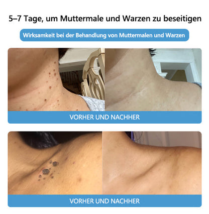 🌻🐝[🌟Offizieller Markenshop🌟] LEFUN™ Bienengift Maulwurf und Warze Behandlung Creme(👨‍⚕AAD EMPFIEHLT)