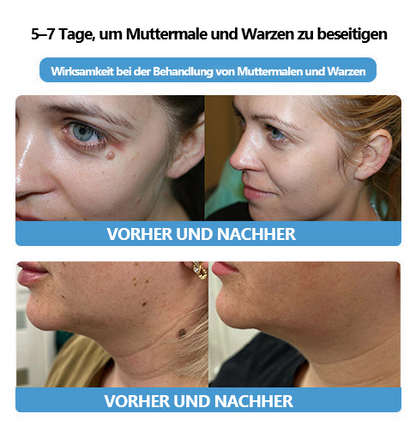 🌻🐝[🍀Offizieller Markenshop🍀] LEFUN™ Bienengift Maulwurf und Warze Behandlung Creme(👨‍⚕AAD EMPFIEHLT)