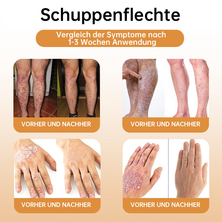 👑👑LIPOGO™ Bienengift Warze & Tag Entfernung Creme(👨‍⚕Für alle Hauttypen geeignet)🐝(🔥Aktion am letzten Tag 70% Rabatt)