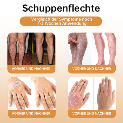 👑👑LIPOGO™ Bienengift Warze & Tag Entfernung Creme(👨‍⚕Für alle Hauttypen geeignet)🐝(🔥Aktion am letzten Tag 70% Rabatt)