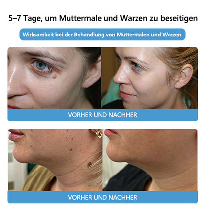 🌻🐝[🌟Offizieller Markenshop🌟] LEFUN™ Bienengift Maulwurf und Warze Behandlung Creme(👨‍⚕AAD EMPFIEHLT)