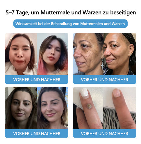 🌻🐝[🌟Offizieller Markenshop🌟] LEFUN™ Bienengift Maulwurf und Warze Behandlung Creme(👨‍⚕AAD EMPFIEHLT)